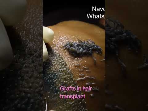 9416500112, HD Live Hair transplant Implantation | Hair Graft looks